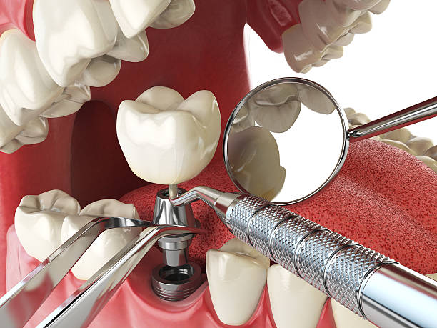 Best Emergency Tooth Extraction in Jennings Lodge, OR
